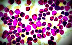 ΝΕΑ ΕΙΔΗΣΕΙΣ (Νέα ταξινόμηση βελτιώνει την πρόβλεψη κινδύνου της λεμφογενούς λευχαιμίας)